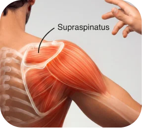 Medical illustration labeled A showing a supraspinatus rotator cuff tear