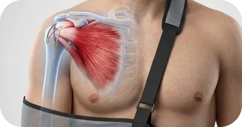 Patient in a sling protecting the shoulder after rotator cuff surgery
