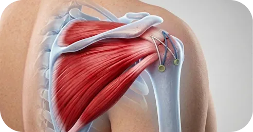 Arthroscopic view of instruments repairing a rotator cuff tendon