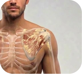 Illustration of fatty infiltration in rotator cuff muscle