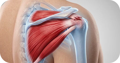 Illustration of shoulder strain risks associated with an untreated rotator cuff tear