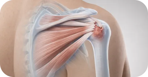Illustration of rotator cuff tear progression when surgery is delayed