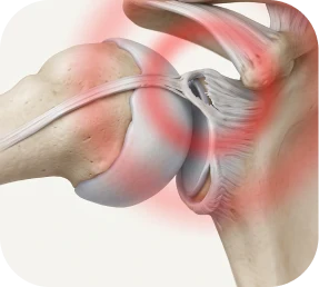 Illustration of rotator cuff repair with SLAP lesion repair