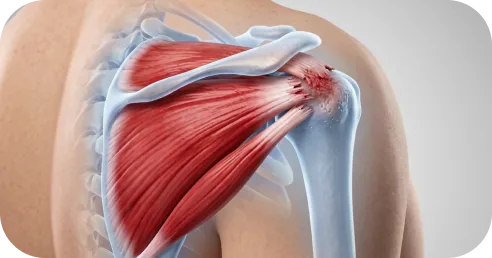 Illustration explaining why detached rotator cuff tendons rarely heal without treatment