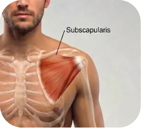 Medical illustration labeled C showing a subscapularis rotator cuff tear