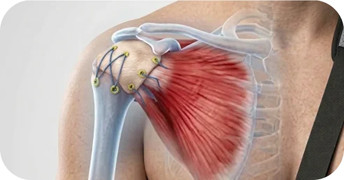 Illustration of superior capsule reconstruction graft placement for massive rotator cuff tears