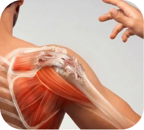 Illustration of tendon degeneration with wear and fraying