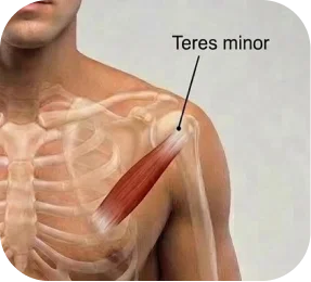 Medical illustration labeled D showing a teres minor rotator cuff tear