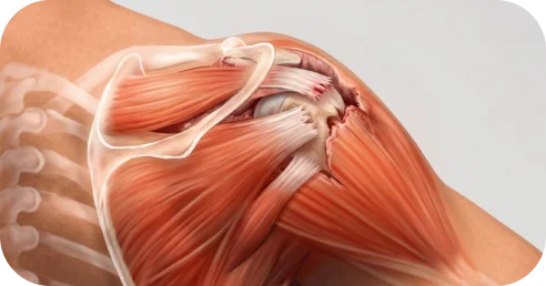 Illustration of rotator cuff tear size from small through massive