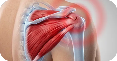 Physical therapist guiding shoulder therapy for rotator cuff symptoms