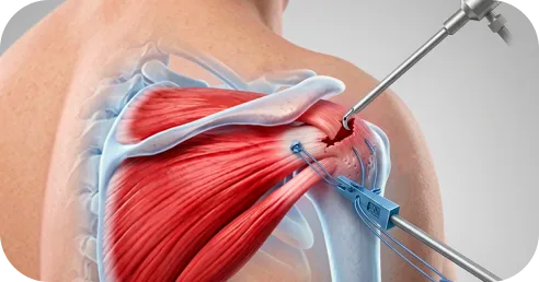Step sequence of arthroscopic rotator cuff repair with suture anchors