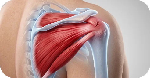 Graphic comparing partial versus full thickness rotator cuff tendon tears