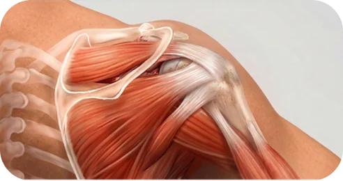 Diagram showing levels of rotator cuff tendon retraction from the bone