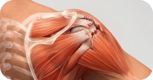 Illustration comparing non-surgical therapy limits versus structural rotator cuff repair needs